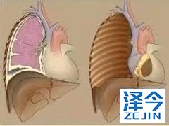 尼达尼布的适用症包括胸膜间皮瘤吗