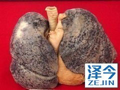 尼达尼布治疗非小细胞肺癌患者效果良好