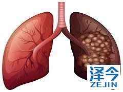 尼达尼布为患者在的治疗提供了选择