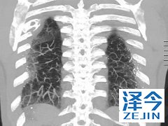 尼达尼布能够为患者带来肺功能的改善