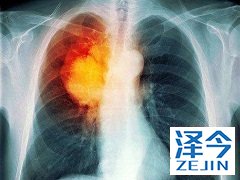 尼达尼布与吡非尼酮联合治疗效果如何