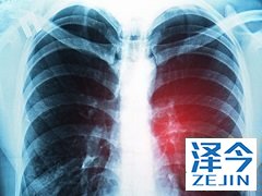 尼达尼布通过抑制血管生成达到治疗的目的