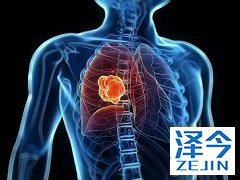 靶向药物尼达尼布能够为非小细胞肺癌提供治疗