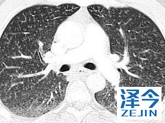 尼达尼布是一种小分子抗肿瘤多激酶抑制剂