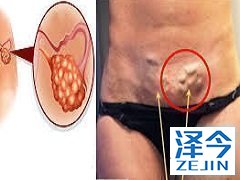 尼达尼布延缓了晚期卵巢癌的进展